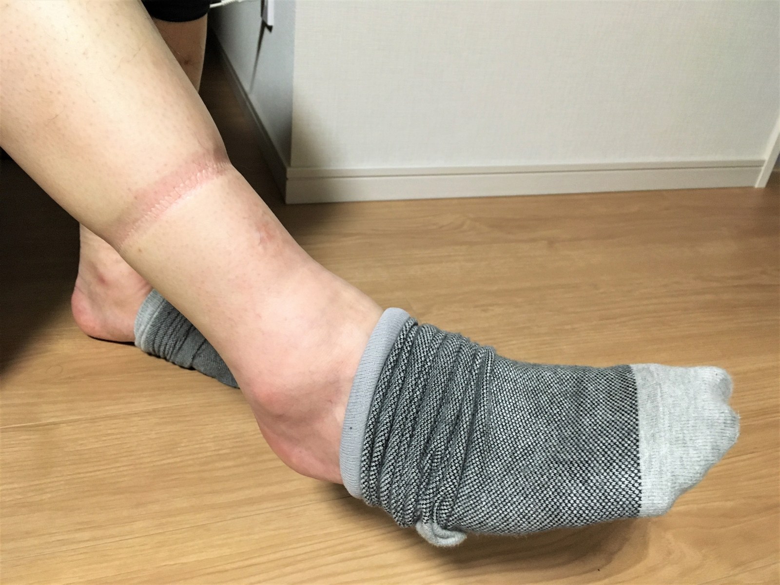 靴下の跡が残った足首