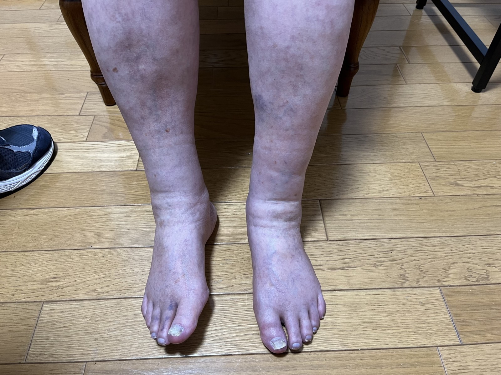 両足のむくみを左右で見比べる
