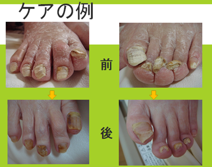 提供資料「ケアの例」に掲載された足のケア前後の比較写真