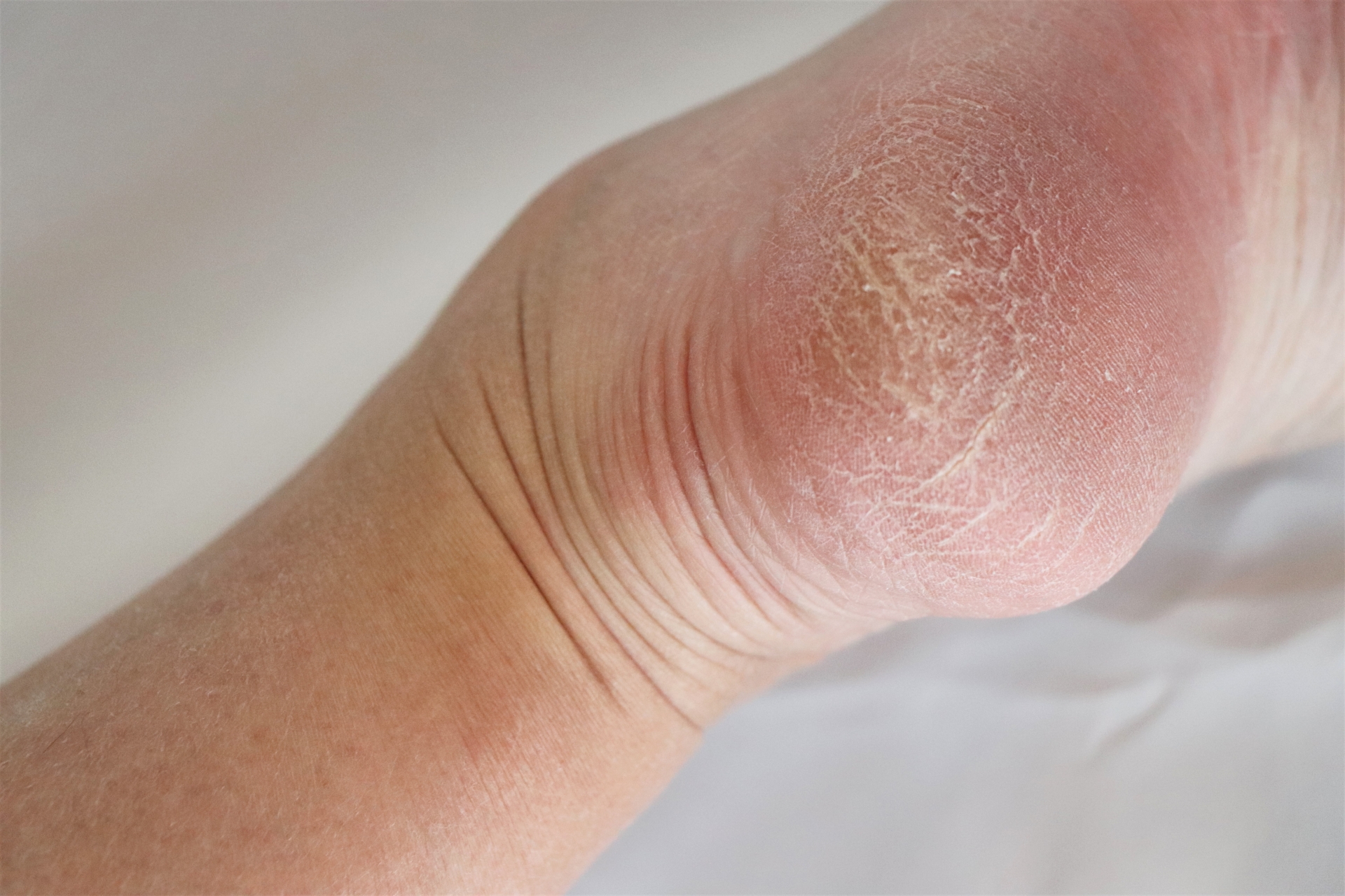 痛みのあるかかとの位置を鏡で確認する様子