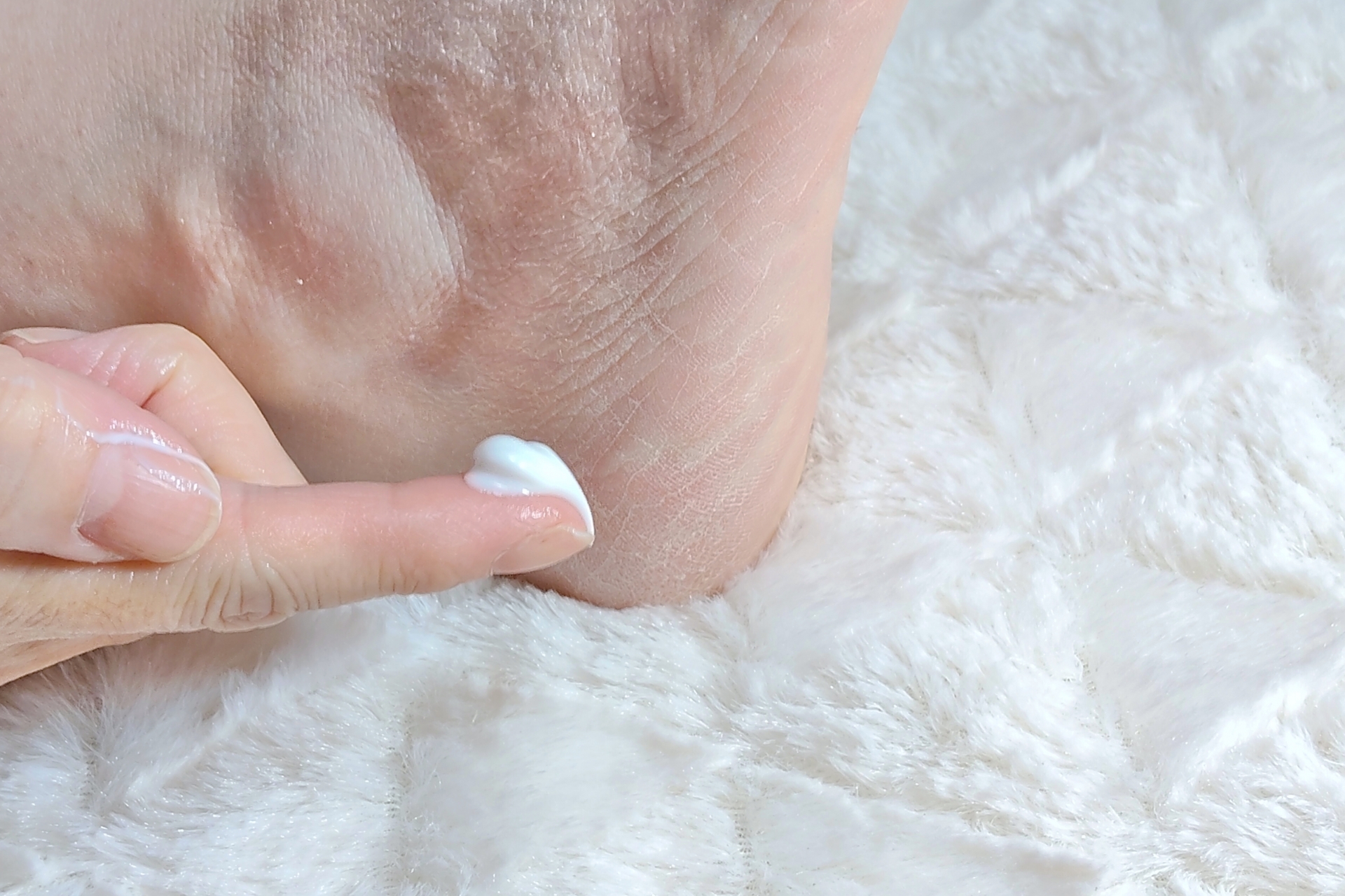 傷のない乾燥したかかとへ保湿剤をやさしく塗る様子